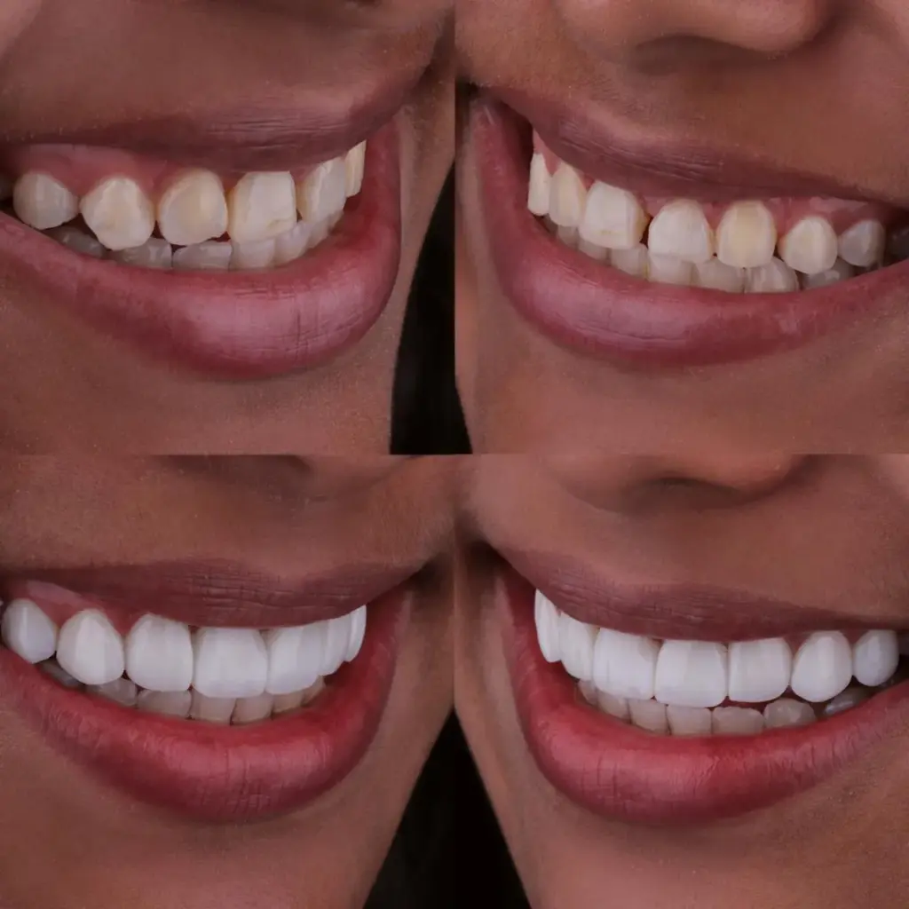 Detalle del antes y después de una sonrisa