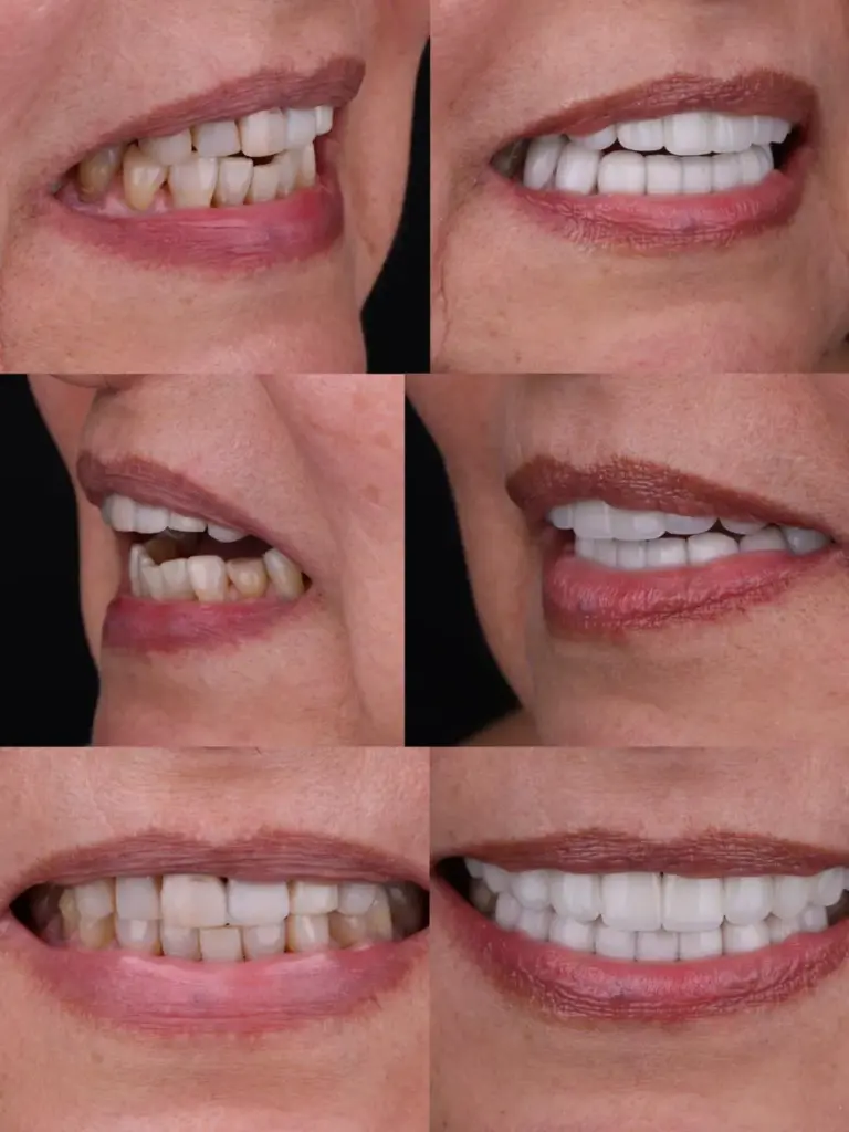 Detalle del antes y después de una sonrisa