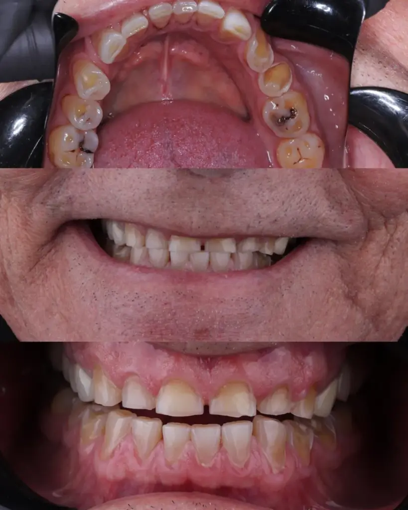 Detalle del antes y después de una sonrisa