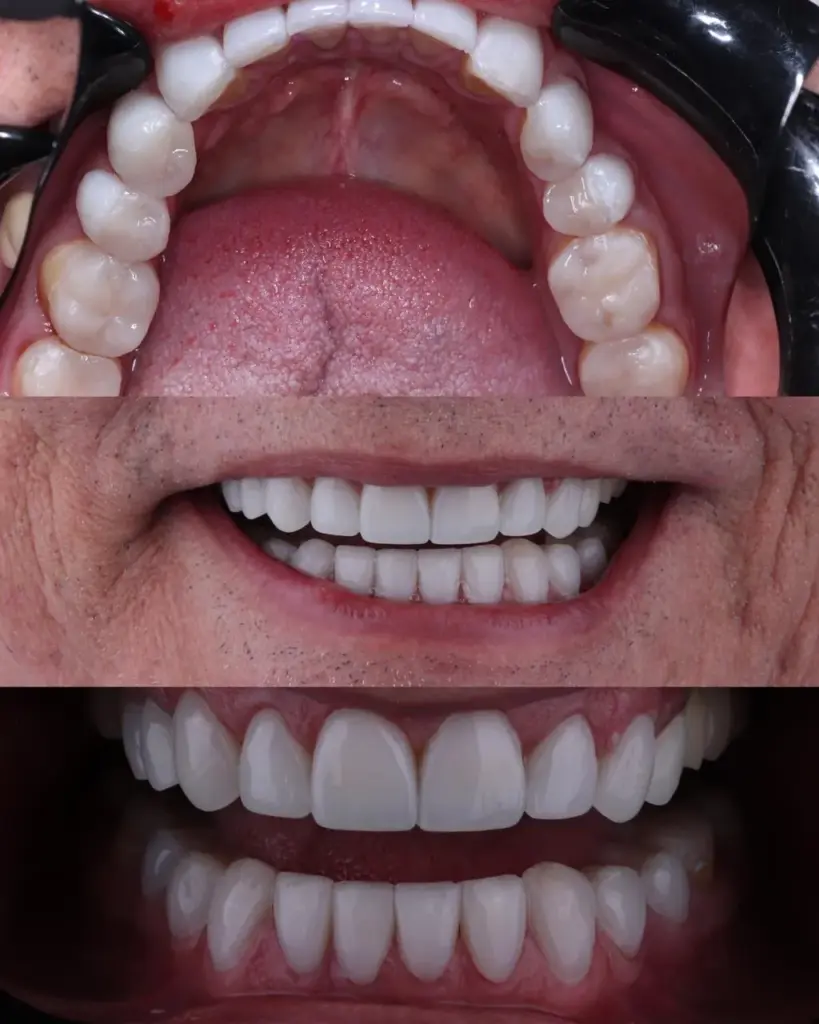 Detalle del antes y después de una sonrisa