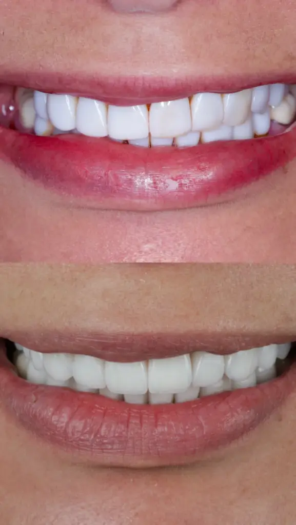 Detalle del antes y después de una sonrisa