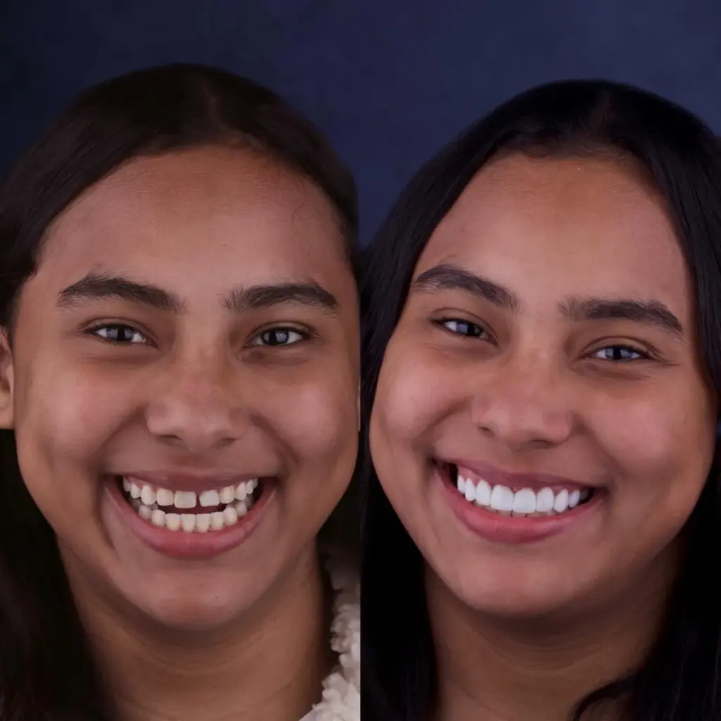 Antes y después de un tratamiento de estética dental