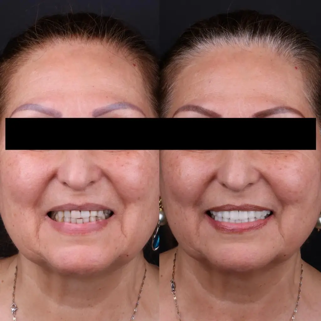 Antes y después de un tratamiento de estética dental