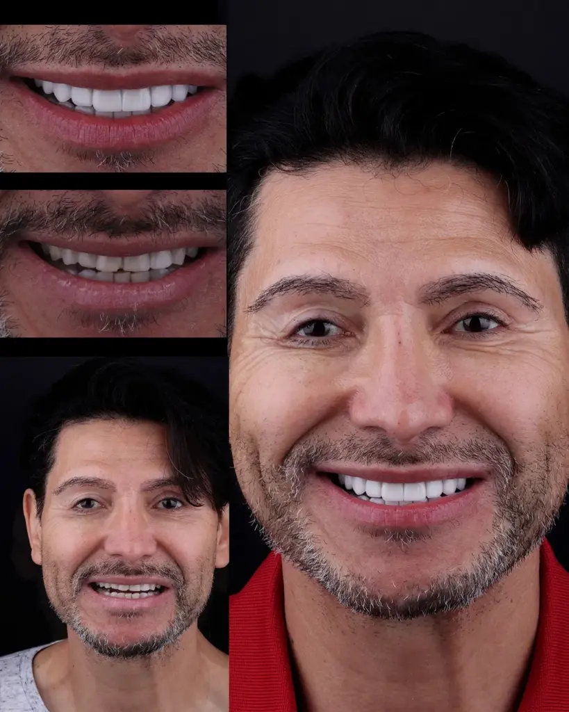 Antes y después de un tratamiento de estética dental