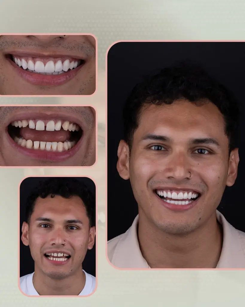Antes y después de un tratamiento de estética dental