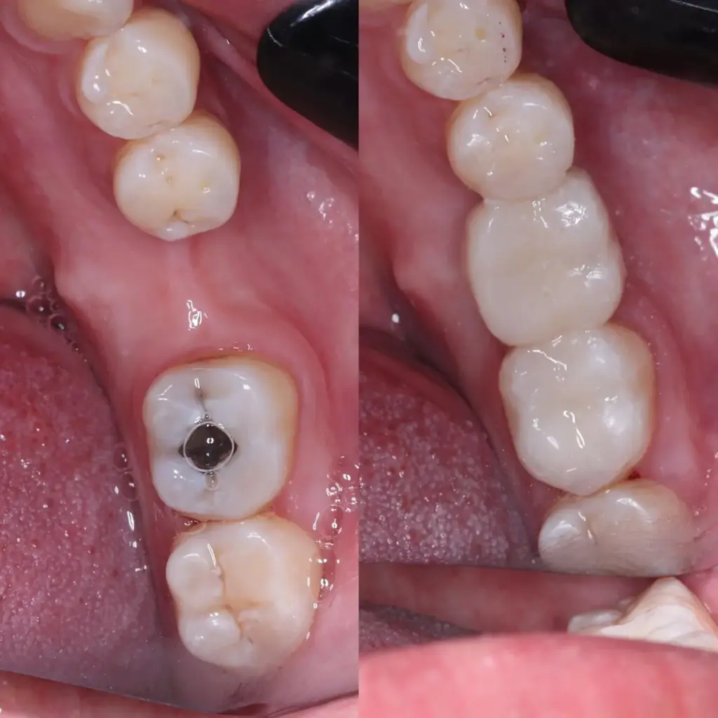 Detalle de restauraciones dentales antes y después